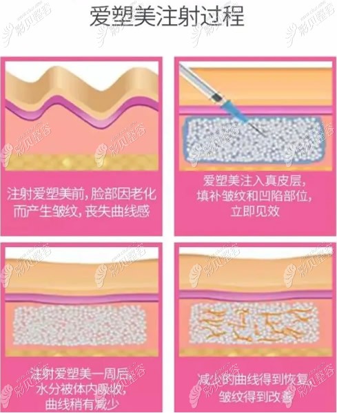 3d童颜针美肌针报道_美颜针和童颜针的区别_3d童颜针价格